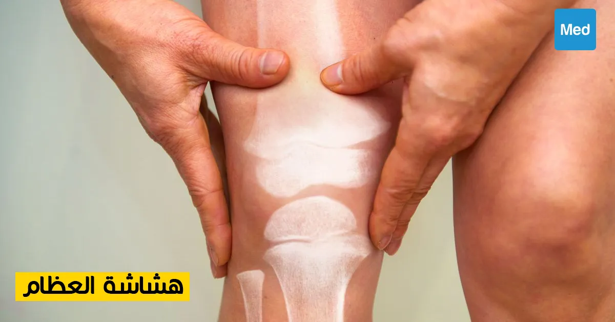 هشاشة العظام